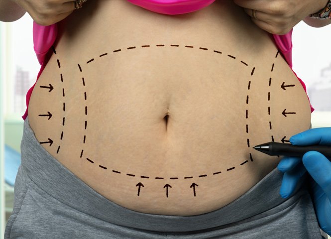 1763749019_tummytuck-2