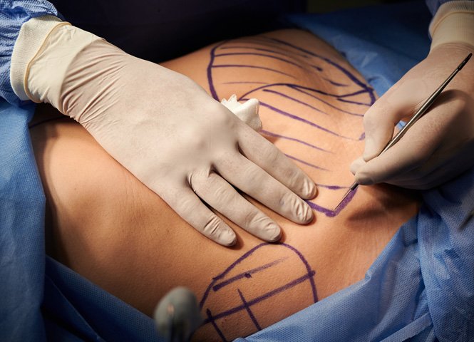 1763749028_tummy-tuck-1