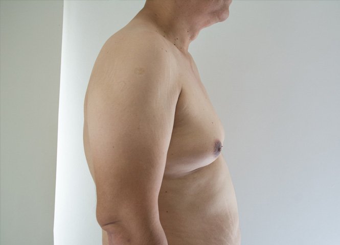1763749203_gynecomastia1