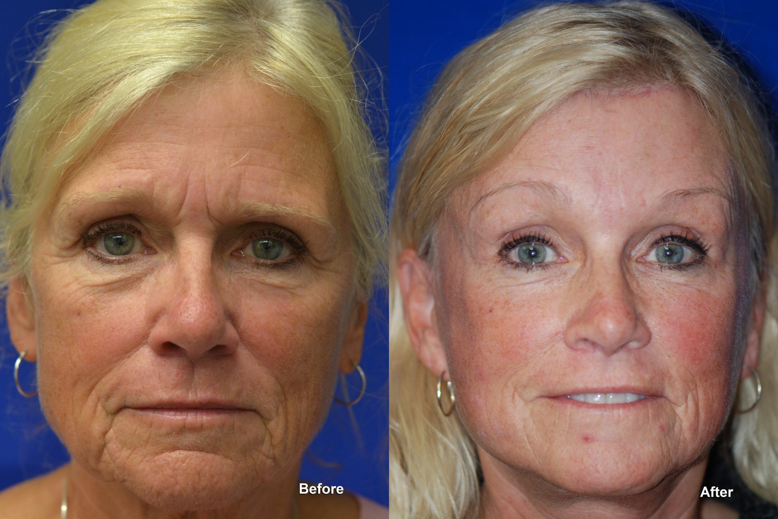 Before and After Image: Facelift - front