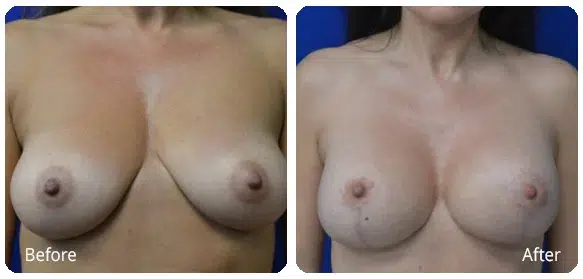 Before and After Image: Breast Augmentation/Mastopexy - front
