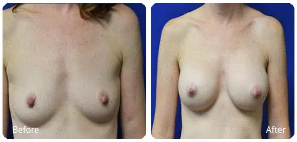 Before and After Image: Breast Augmentation - front
