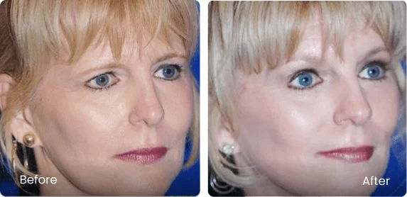 Before and After Image: Brow Lift - front