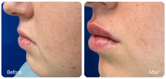 Before and After Image: Injectables - left-side