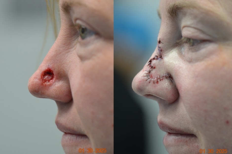 Before and After Image: MOHS Closure - left-side