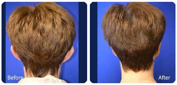 Before and After Image: Otoplasty - back