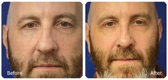 Before and After Image: Rhinoplasty - front