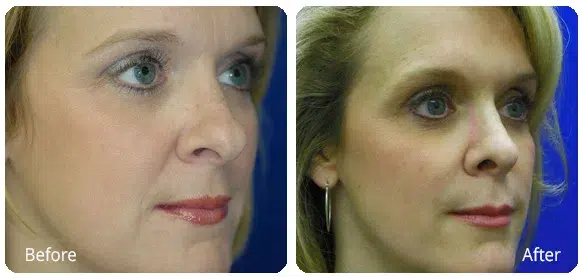 Before and After Image: Rhinoplasty - right-front-oblique
