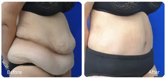 Before and After Image: Abdominoplasty - right-front-oblique