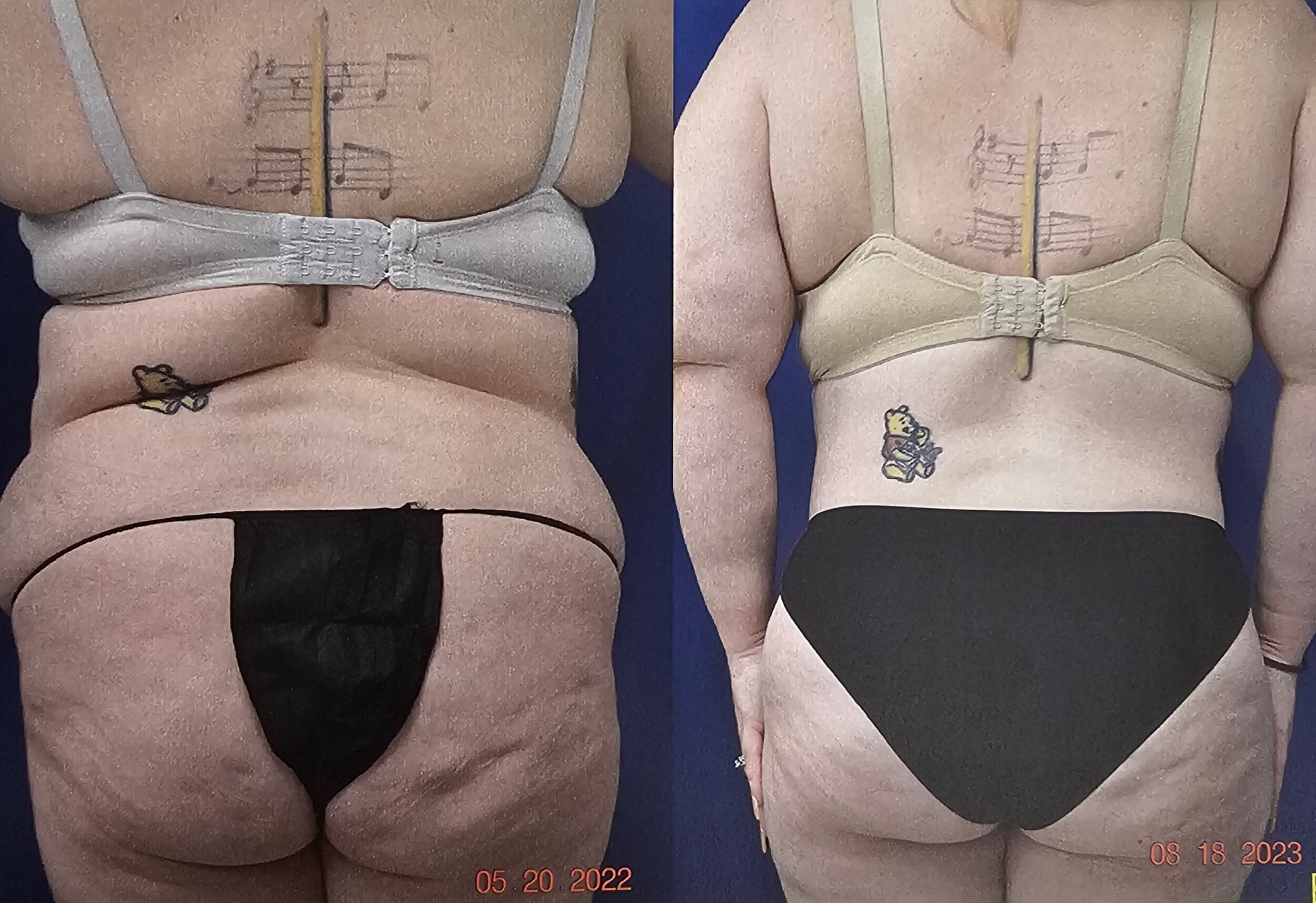 Before and After Image: Abdominoplasty - back