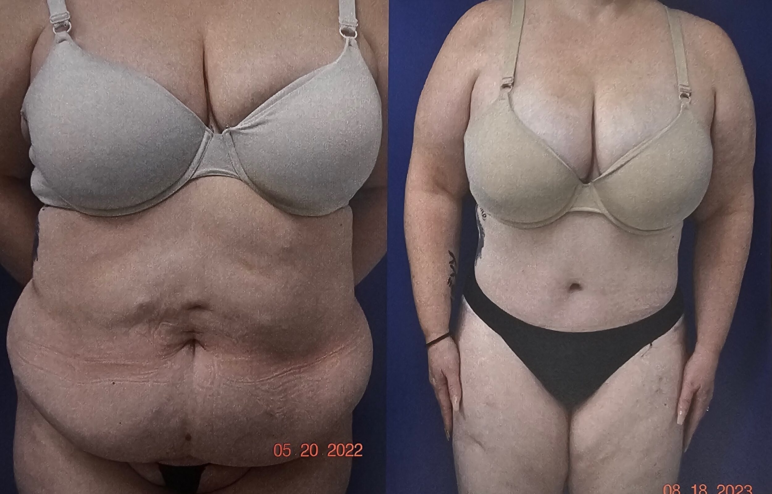Before and After Image: Abdominoplasty - front