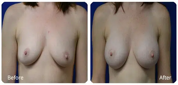 Before and After Image: Breast Augmentation - front