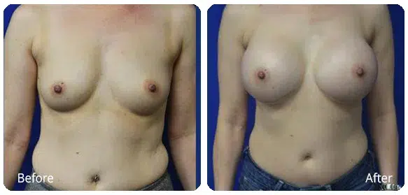 Before and After Image: Breast Augmentation - front