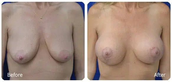 Before and After Image: Breast Augmentation - front