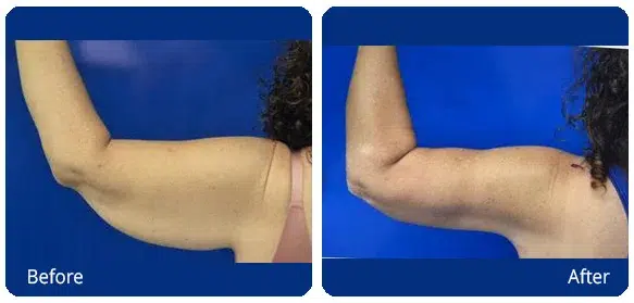 Before and After Image: Brachioplasty - back
