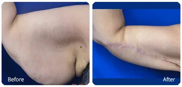 Before and After Image: Brachioplasty - front