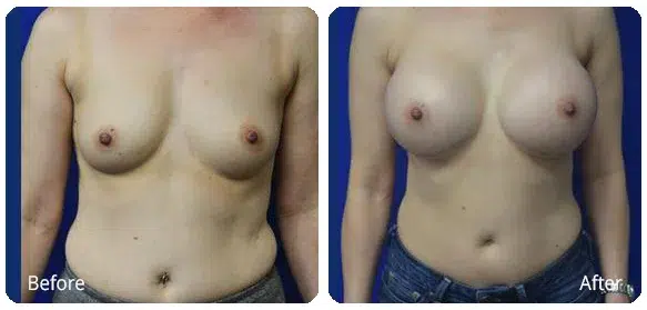 Before and After Image: Breast Augmentation - front