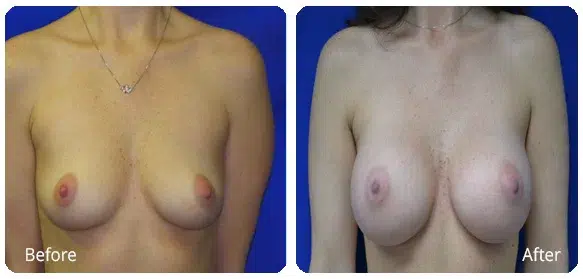 Before and After Image: Breast Augmentation - front