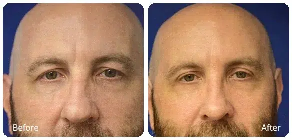 Before and After Image: Eyelid Surgery (Blepharoplasty) - front