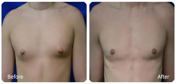 Before and After Image: Gynecomastia - front