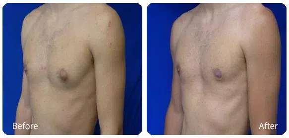 Before and After Image: Gynecomastia - left-front-oblique