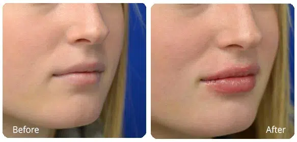 Before and After Image: Injectables - right-front-oblique