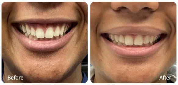 Before and After Image: Injectables - front