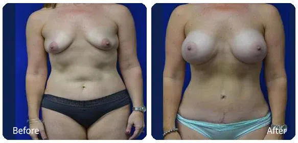 Before and After Image: Mommy Makeover - front