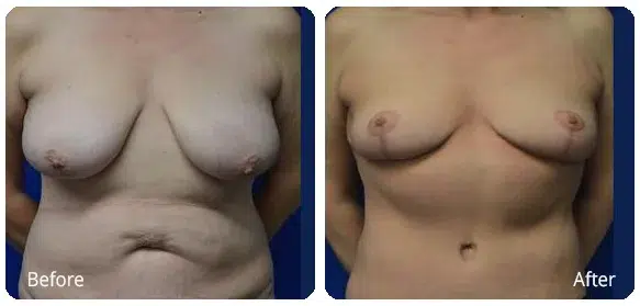 Before and After Image: Mommy Makeover - front