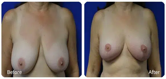 Before and After Image: Breast Reduction - front