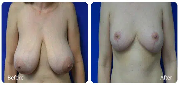 Before and After Image: Breast Reduction - front
