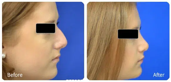 Before and After Image: Rhinoplasty - right-side