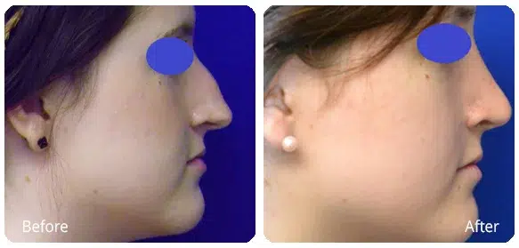 Before and After Image: Rhinoplasty - right-side