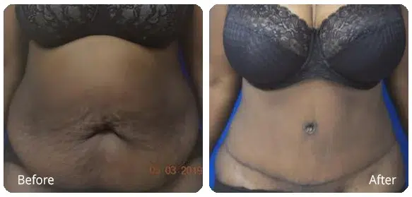 Before and After Image: Abdominoplasty - front
