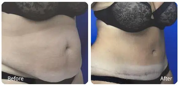 Before and After Image: Abdominoplasty - right-front-oblique