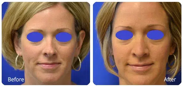 Before and After Image: Rhinoplasty - front