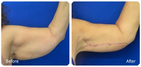 Before and After Image: Brachioplasty - front