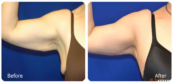 Before and After Image: Brachioplasty - front