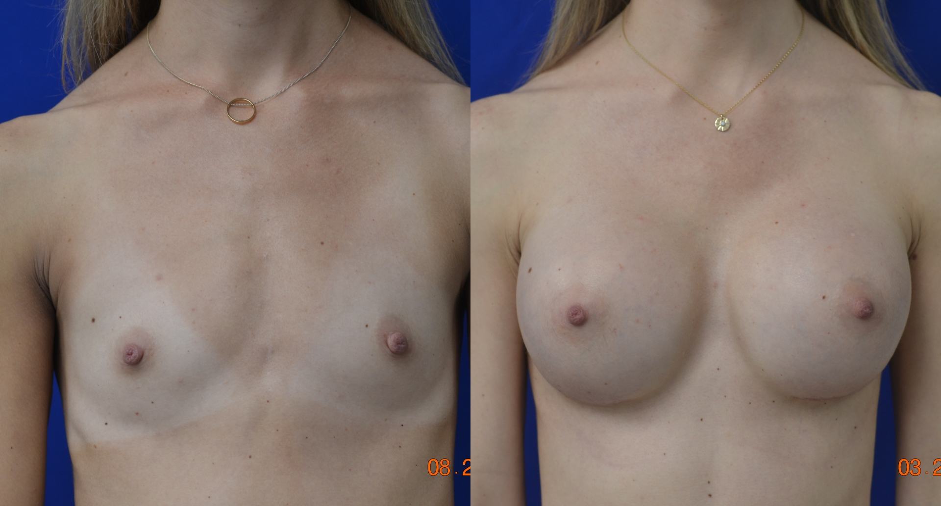Before and After Image: Breast Augmentation - front
