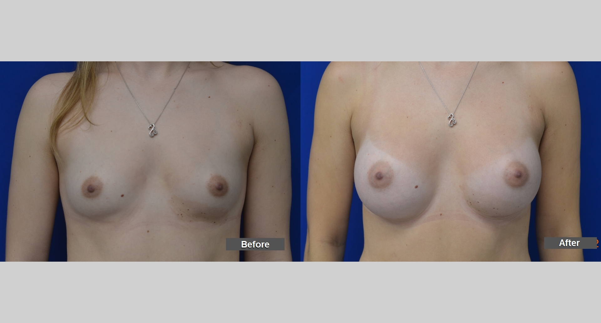 Before and After Image: Breast Augmentation - front
