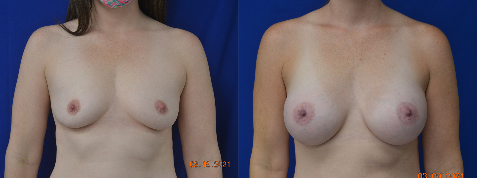 Before and After Image: Breast Augmentation - front