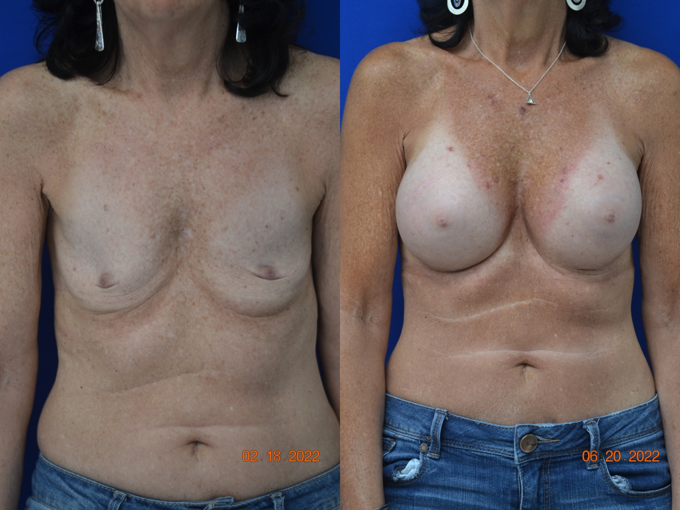 Before and After Image: Breast Augmentation - front