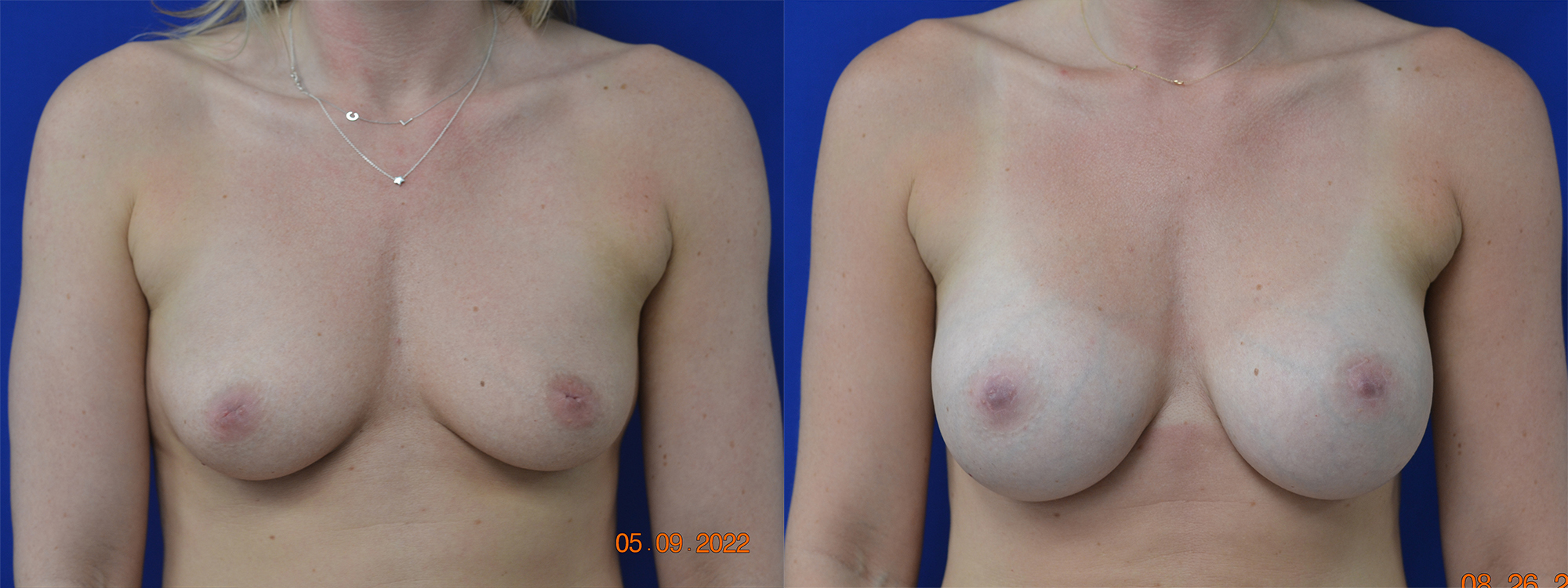 Before and After Image: Breast Augmentation - front