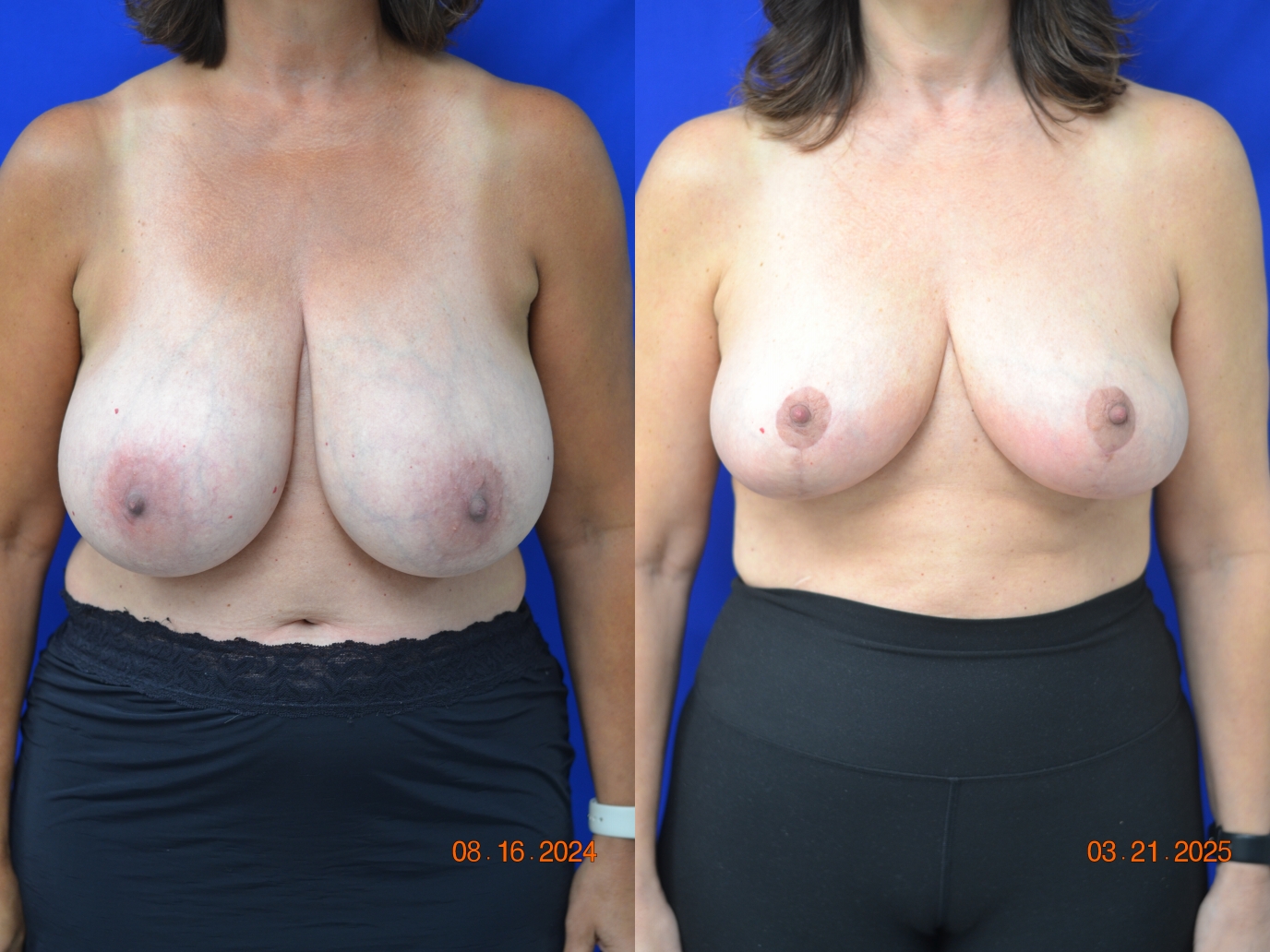 Before and After Image: Breast Reduction - front