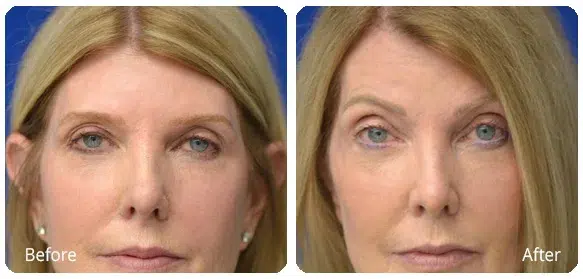 Before and After Image: Brow Lift - front