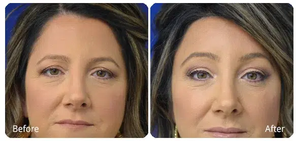 Before and After Image: Brow Lift - front