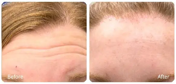 Before and After Image: Injectables - front