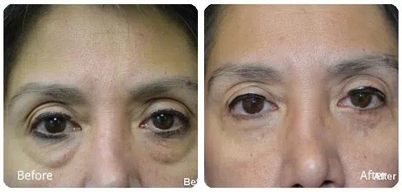 Before and After Image: Eyelid Surgery (Blepharoplasty) - front
