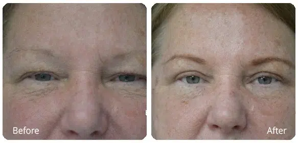 Before and After Image: Eyelid Surgery (Blepharoplasty) - front