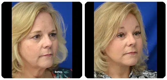 Before and After Image: Facelift - right-front-oblique